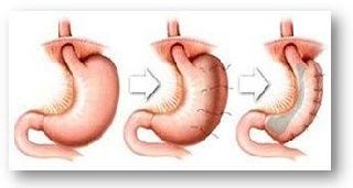 Laparoscopic Gastric Plication