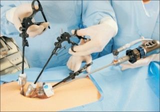 Single Incision Laparoscopic Surgery SILS System Provides Surgeons And Patient With The Most