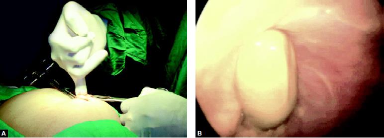 Finger insertion after open access will confirm adhesion