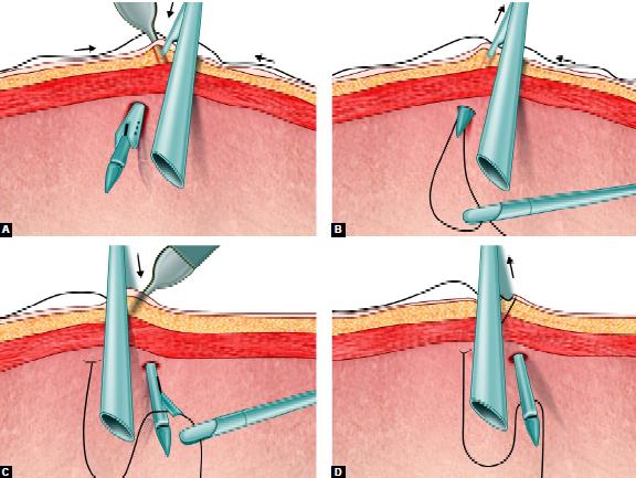 Port closure with the help of suture passer