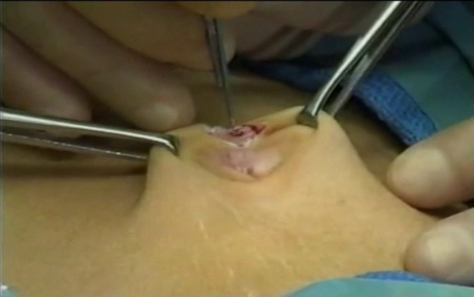 Skin Incision for Open Technique