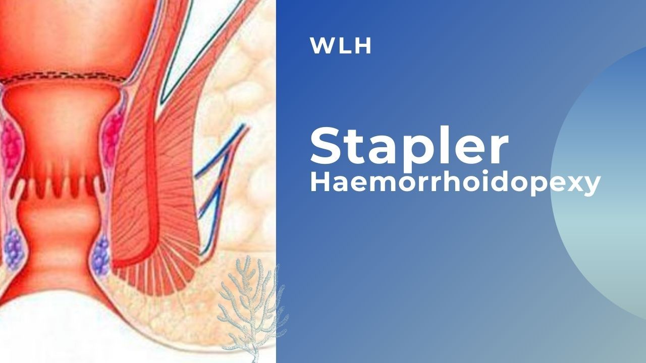 Stapler Haemorrhoidopexy