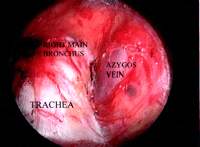 Mediastinoscopy