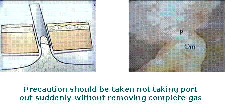 Adhesion may form if cannula is pulled rapidly at the end of surgery