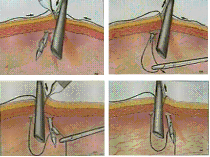 Port closure with the help of suture passer