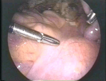 Incision point for Presacral Neurectomy