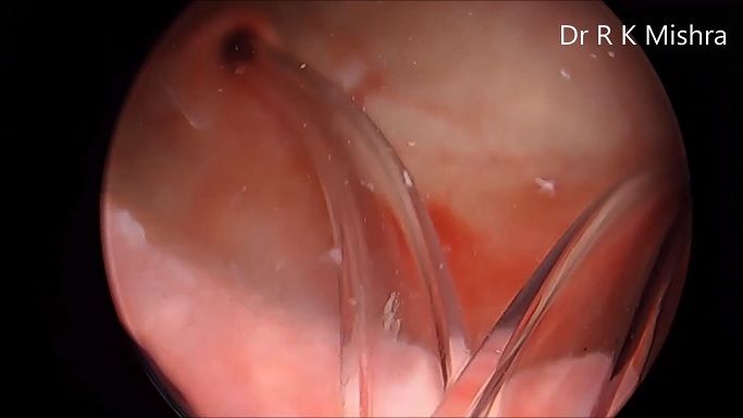 Infrared Ureteral Stent