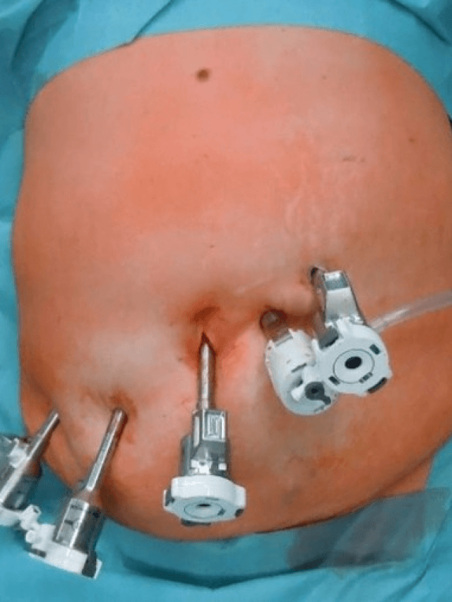 Laparoscopic and Robotic Cholecystectomy (removal of diseased gallbladder)