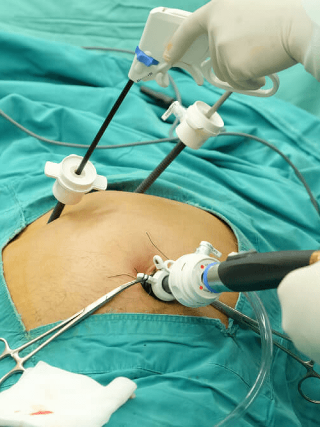 Laparoscopic and Robotic CBD Exploration