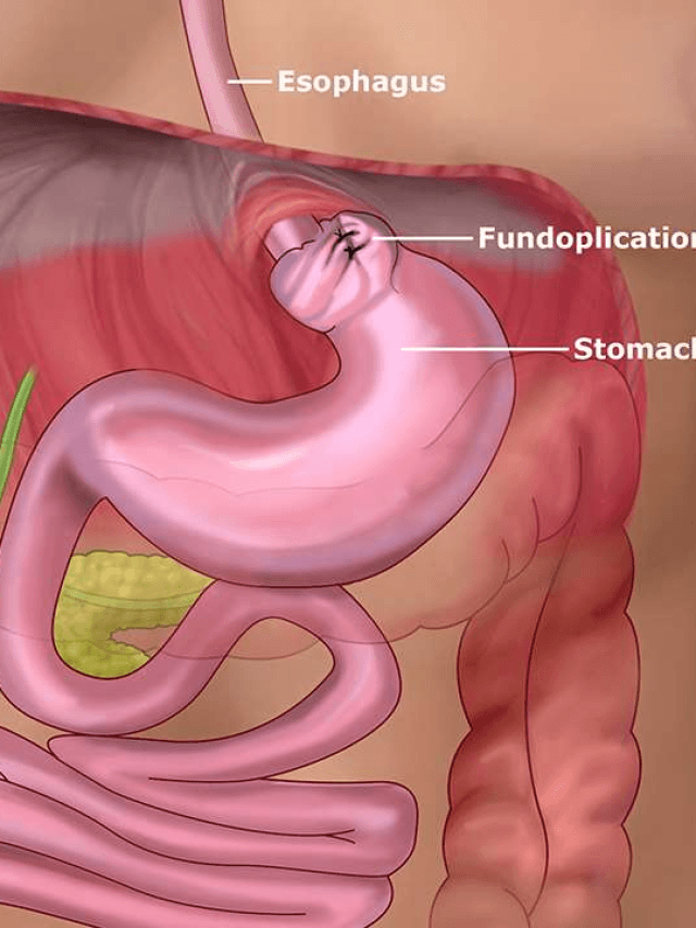 Laparoscopic and Robotic Fundoplication. (for gastro-esophageal reflux disease)