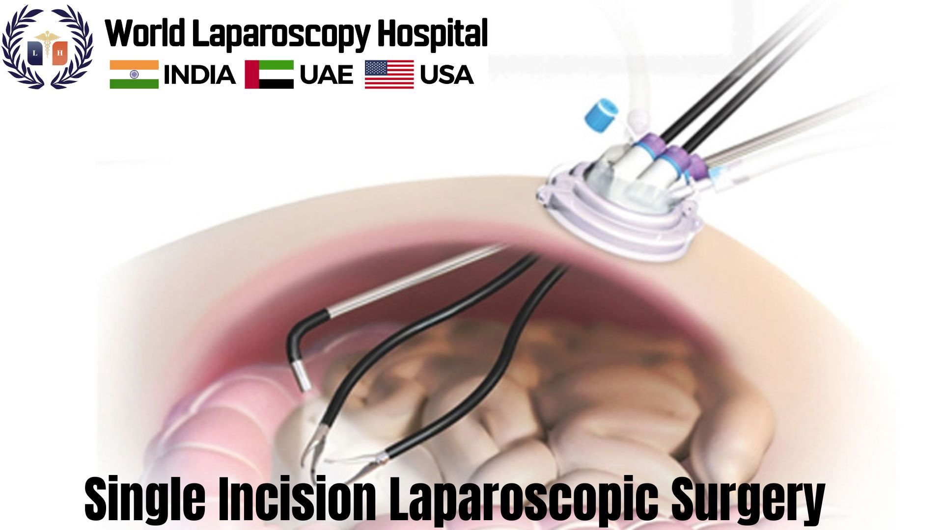 Single Incision Laparoscopic Surgery Dr R K Mishra