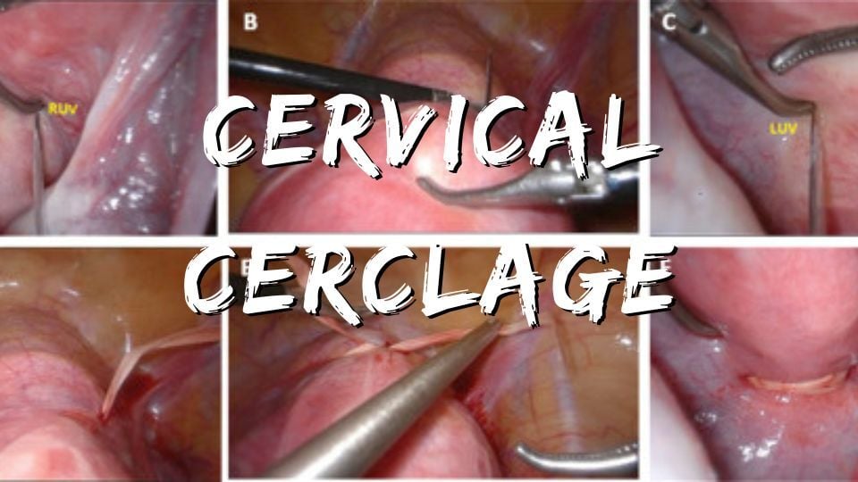 Laparoscopic Cervical Cerclage