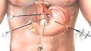 Laparoscopic Fundoplication