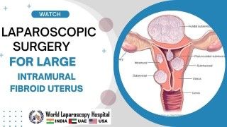 Laparoscopic Precision: Revolutionizing Treatment for Large Intramural Fibroid Uterus