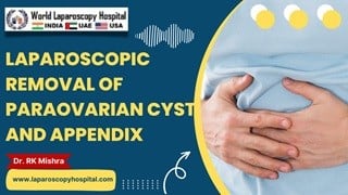 Laparoscopic Removal of Paraovarian Cyst and Appendix: Advances in Minimally Invasive Surgery