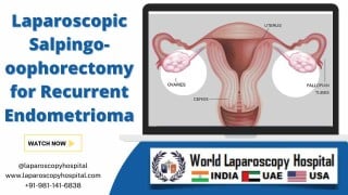 Laparoscopic Salpingo-oophorectomy for Recurrent Endometrioma