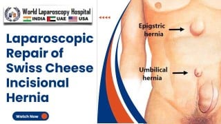 Minimally Invasive Approach to Swiss Cheese Incisional Hernia Repair: A Laparoscopic Solution