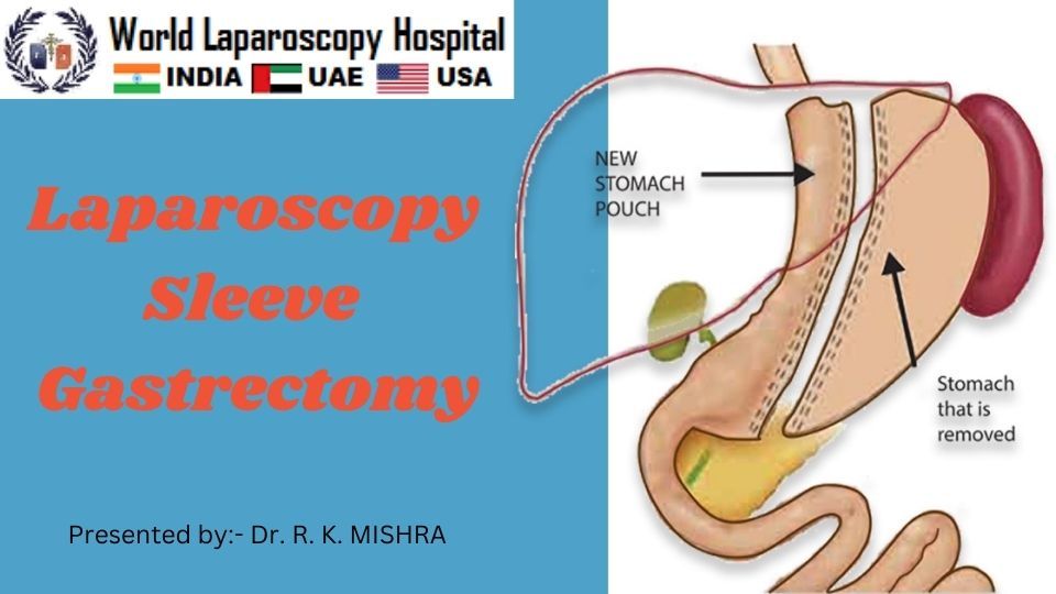 How To Perform Laparoscopic Sleeve Gastrectomy Step By Step What Are The Complication Of This 1856