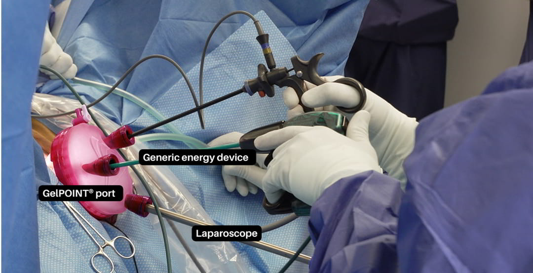 Recent Advancements in Vnotes Surgery: Revolutionizing Minimally ...