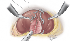 نتائج استئصال الكلية الجزئي بالمنظار لدى المرضى الذين يواصلون علاج الأسبرين