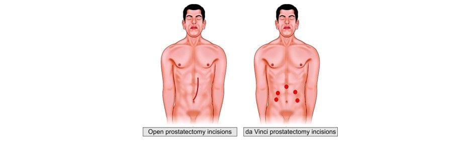 Comparison between open and da Vinci prostatectomy