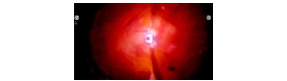 Camera port insertion under vision with 0° endoscope and optiview cannula