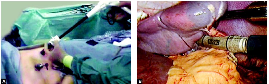 Use of endo GI linear stapler or vascular stapler can make the laparoscopic splenectomy easy but many surgeon use extracorporeal knot as their main skill to secure splenic umenti