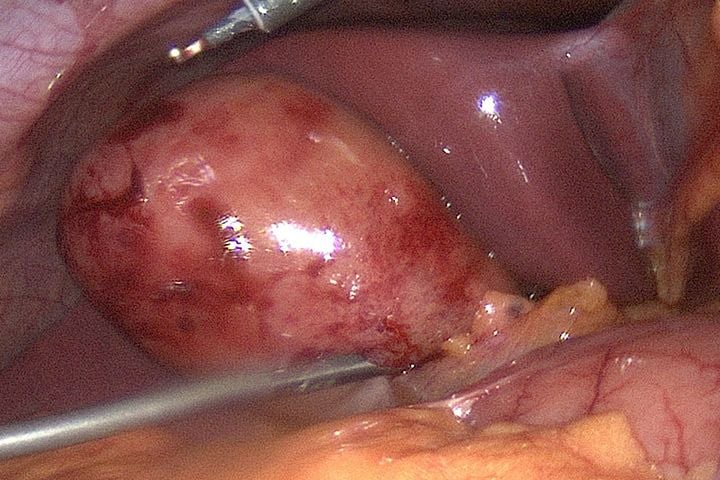 Acute Cholecystitis