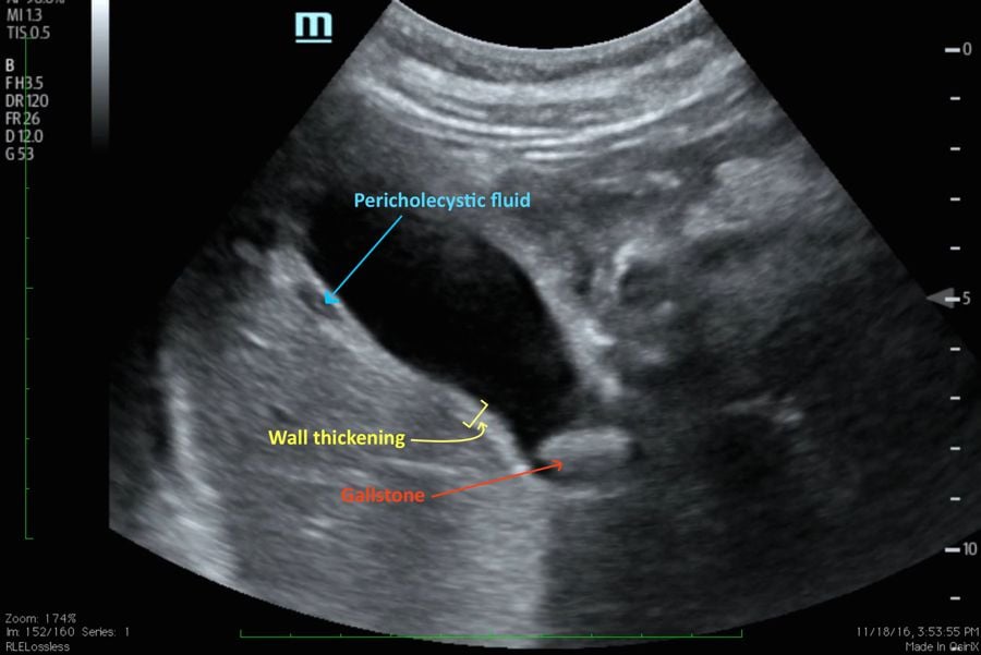 USG Findings in Aute Cholecystitis