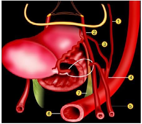 Anatomy of uterus. (1) Umbilical artery; (2) Ureter; (3) Uterine artery; (4) Internal iliac artery; (5) Ovarian artery; (6) Common iliac artery; (7) Uterosacral ligament