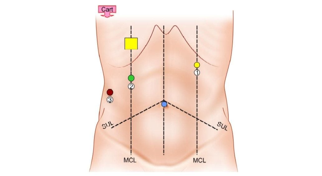 Position of patient cart and ports