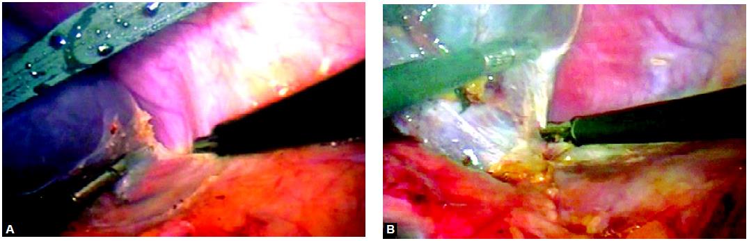 Dissection of the inferior aspect of the spleen