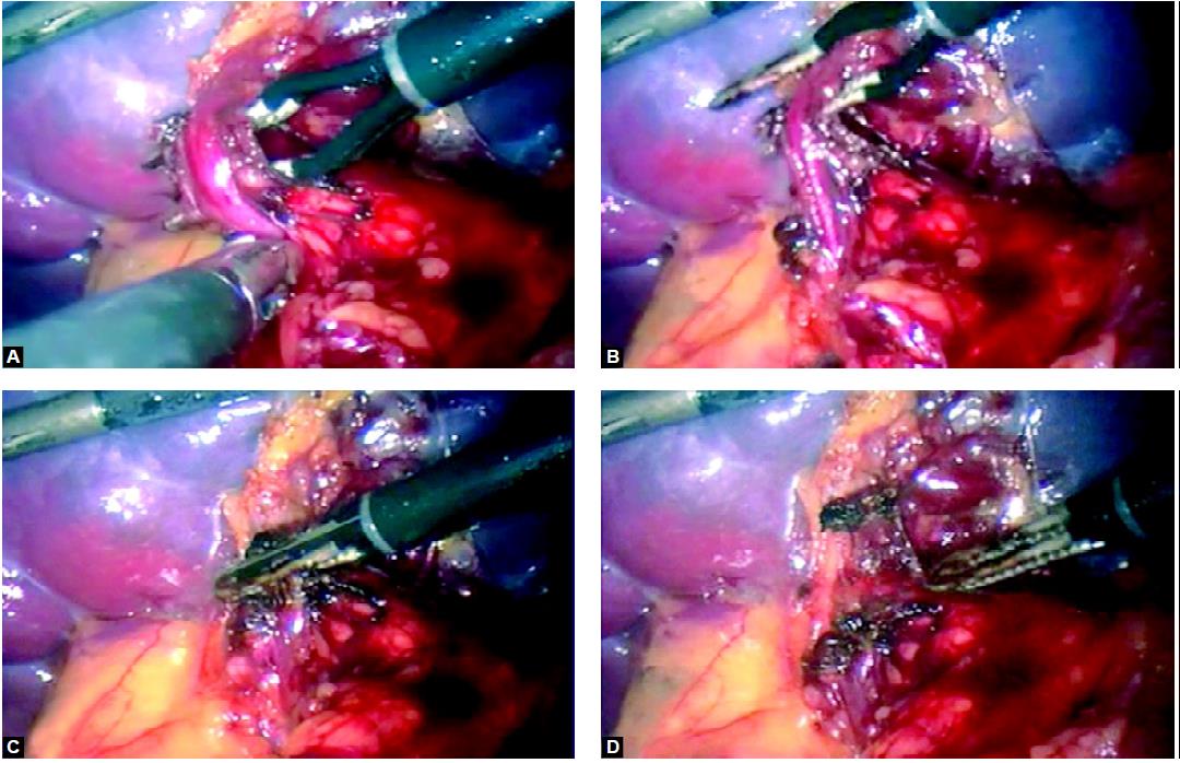 Dissection of splenic hilum