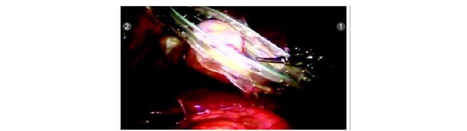 Gallbladder placed in endobag