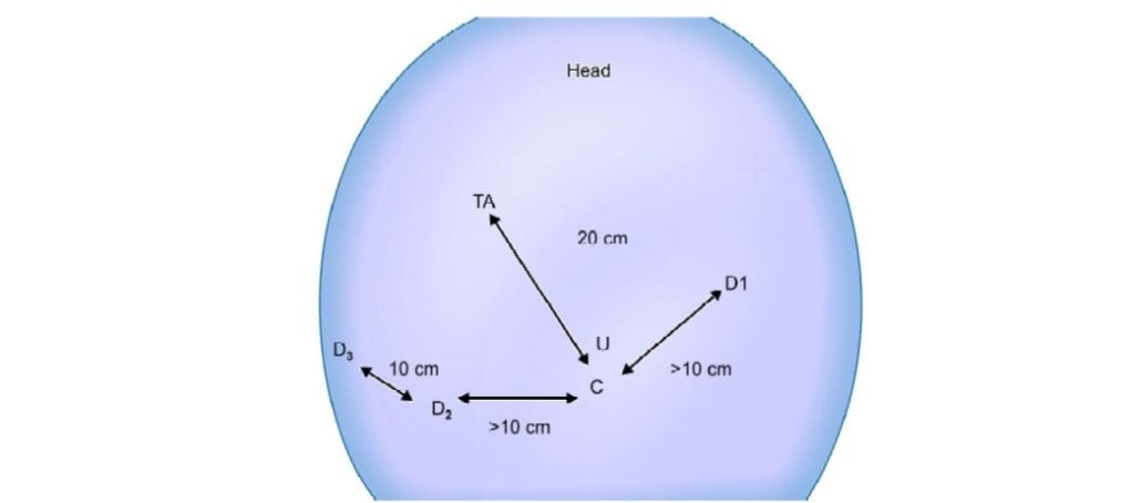 Port positioning (TA: Target anatomy)