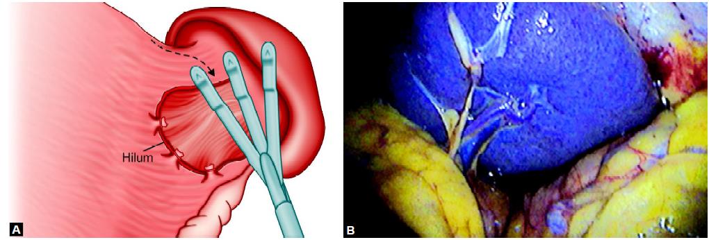 Retractor is necessary to expose the hilum of the spleen