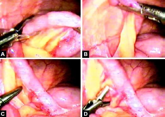 Retraction of an appendix