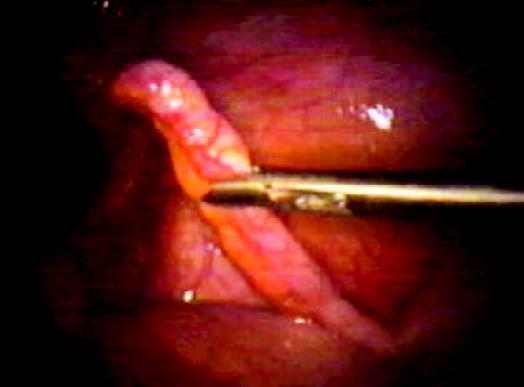 Retraction of an appendix