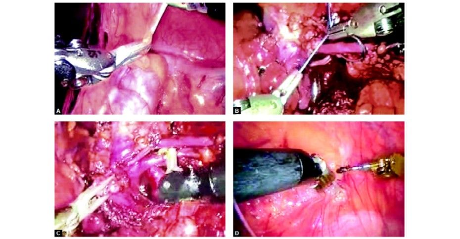 Robotic assisted nephrectomy