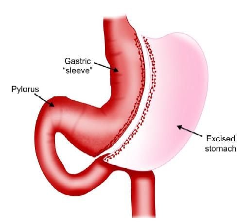 Sleeve gastrectomy