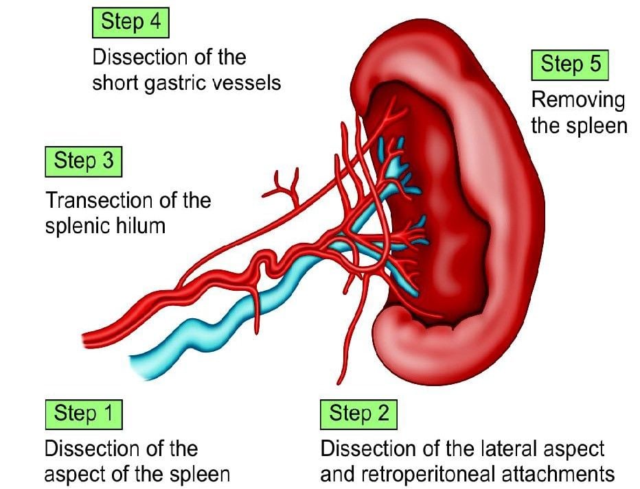 Various steps of splenectomy