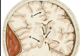 लैपारोस्कोपी के दौरान रोगी की स्थिति के प्रभाव पर इंट्राक्रैनियल दबाव (Intracranial Pressures) का परिणाम 