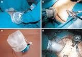 Hand-Assisted Laparoscopic Surgery Getting Popular