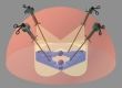 Wireless microcamera clusters laparoscopic imaging