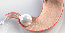 Transpyloric shuttle device to reduce the rate of gastric outflow