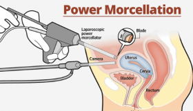 Power Morcellator Patient Advocate Dies