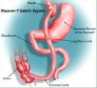 Weight Loss Surgery Cures Type 2 Diabetes for Most  of the Patient