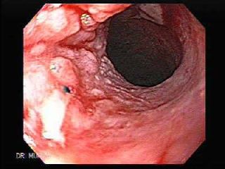 Cholecystectomy as a risk factor for oesophageal adenocarcinoma