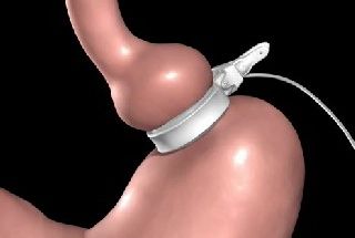 Gastric Banding is slowly becoming Outdated Laparoscopic Bariatric Surgery