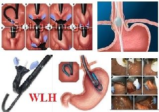 Plicator Endoscopic Treatment for Gastroesophageal Reflux Disease